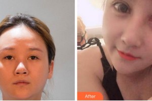 臺州國際眼科醫(yī)院張芳整形價格表附眼部綜合案例展示