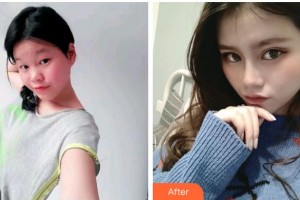 臺州國際眼科醫(yī)院葉良整形價格表附眼部綜合案例展示