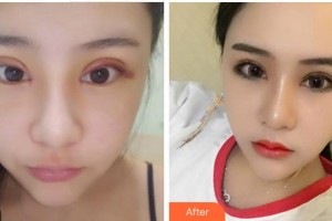 臺州國際眼科醫(yī)院余煥云整形價格表附切開雙眼皮案例展示