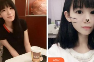 臺州國際眼科醫(yī)院曉整形價格表附切開雙眼皮案例展示