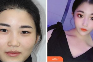 臺州國際眼科醫(yī)院徐肅仲整形價格表附眼部綜合案例展示