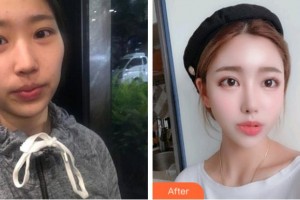 臺州國際眼科醫(yī)院許金玲整形價格表附切開雙眼皮案例展示