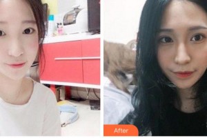 臺州國際眼科醫(yī)院陳惠整形價格表附埋線雙眼皮案例展示