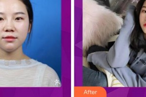 麗水慈愛(ài)醫(yī)院整形美容中心宋秀旭整形價(jià)格表附耳軟骨復(fù)合隆鼻案例展示