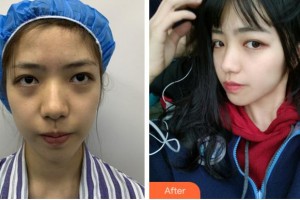 麗水思齊整形外科門(mén)診部BrianKinney整形價(jià)格表附埋線(xiàn)提升案例展示