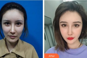 四川美萊醫(yī)學(xué)美容醫(yī)院夏秋整形價(jià)格表附埋線提升案例展示