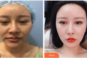 四川西嬋整形美容醫(yī)院邵文輝整形價(jià)格表附埋線提升案例展示