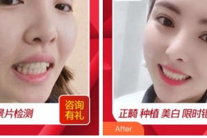 四川西嬋整形美容醫(yī)院謝文揚(yáng)教授整形價(jià)格表附貴金屬烤瓷牙案例展示