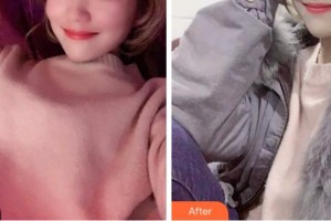 四川西嬋整形美容醫(yī)院孟家麟教授、整形價(jià)格表附超聲波潔牙案例展示