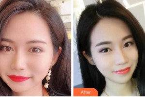 四川西嬋整形美容醫(yī)院馮彤整形價(jià)格表附埋線提升案例展示