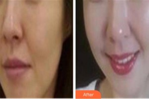 四川西嬋整形美容醫(yī)院楊曉惠整形價(jià)格表附埋線提升案例展示