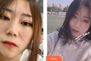 四川華人醫(yī)聯(lián)整形美容醫(yī)院廖萬斌整形價(jià)格表附光子嫩膚案例展示