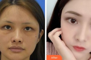 四川省人民醫(yī)院整形外科張家建整形價格表附埋線提升案例展示