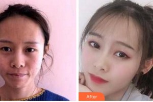 四川美萊醫(yī)學(xué)美容醫(yī)院韓國棟整形價格表附埋線提升案例展示