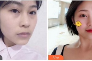 四川武警總隊醫(yī)院樂山分院燒傷整形科帥秀蓉整形價格表附埋線提升案例展示