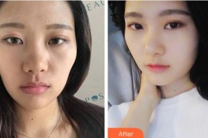 四川美萊醫(yī)學(xué)美容醫(yī)院宋奉宜整形價格表附熱瑪吉案例展示