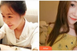 四川美萊醫(yī)學美容醫(yī)院李殷政整形價格表附熱瑪吉案例展示