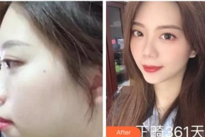 四川美萊醫(yī)學美容醫(yī)院吳幼文整形價格表附金屬托槽矯正案例展示