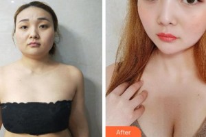 四川西嬋整形美容醫(yī)院黃富偉住院醫(yī)師整形價格表附自體脂肪隆胸案例展示