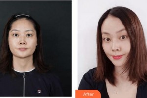 四川西嬋整形美容醫(yī)院林燕整形價(jià)格表附嫩膚祛斑案例展示