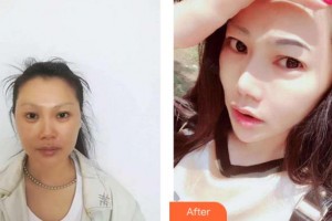 四川圣麗整形美容醫(yī)院肖開宇整形價格表附光子嫩膚案例展示