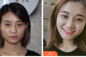 四川圣麗整形美容醫(yī)院董秀清整形價(jià)格表附埋線提升案例展示