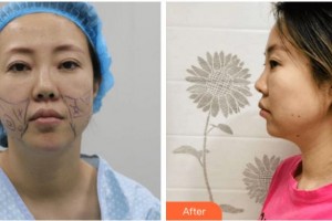 四川圣麗整形美容醫(yī)院王才惠整形價格表附埋線提升案例展示