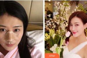 四川省紅十字腫瘤醫(yī)院整形科張大紅整形價格表附鼻部綜合案例展示