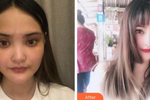 四川省紅十字腫瘤醫(yī)院整形科虞冬梅整形價(jià)格表附耳軟骨復(fù)合隆鼻案例展示