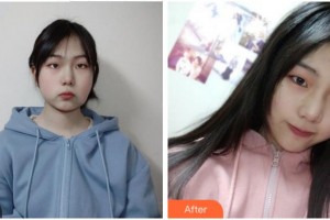 四川華美紫馨醫(yī)學美容醫(yī)院黃劍美整形價格表附埋線提升案例展示