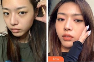 四川華美紫馨醫(yī)學美容醫(yī)院王小玉整形價格表附埋線提升案例展示