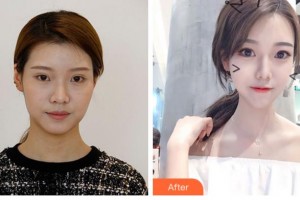 四川華美紫馨醫(yī)學(xué)美容醫(yī)院陳揚整形價格表附埋線提升案例展示