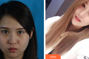 深圳悅己醫(yī)療美容醫(yī)院張珉整形價格表附耳軟骨復(fù)合隆鼻案例展示