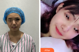 深圳奧拉克醫(yī)療美容診所柳錫鉉整形價格表附超微小氣泡案例展示