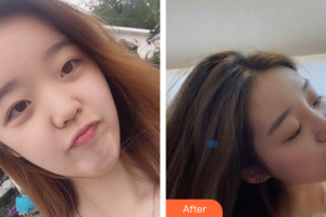 深圳瑞芙臣醫(yī)療美容門診部曾輝武整形價格表附鼻部整形案例展示