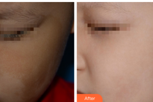 四川西嬋整形美容醫(yī)院何波整形價格表附激光祛斑案例展示