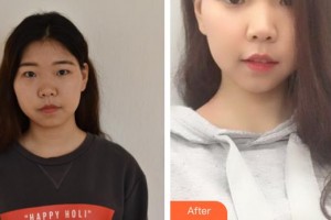 四川華美紫馨醫(yī)學(xué)美容醫(yī)院劉建民整形價格表附激光祛斑案例展示