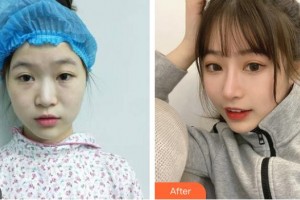 四川軍大醫(yī)學(xué)研究所附屬醫(yī)院美容整形科蒲小兵整形價格表附膨體隆鼻案例展示