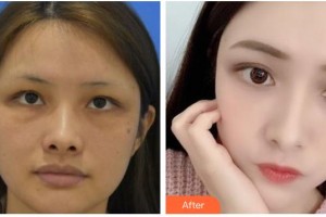 四川西嬋泛亞醫(yī)學(xué)美容醫(yī)院孫得紅整形價(jià)格表附埋線提升案例展示