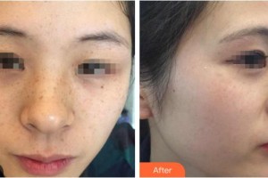 自貢均閣醫(yī)學(xué)美容連鎖謝仕喬整形價(jià)格表附光子嫩膚案例展示