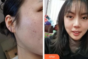 自貢市第四人民醫(yī)院整形美容科曾妮整形價(jià)格表附光子嫩膚案例展示