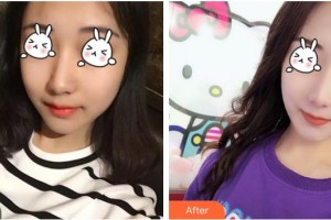 自貢市第四人民醫(yī)院整形美容科何建霖住院醫(yī)師整形價(jià)格表附光子嫩膚案例展示