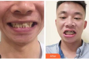 自貢維樂(lè)新橋口腔門診部米蓉整形價(jià)格表附牙齒隱形矯正案例展示