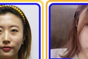 攀枝花愛(ài)爾眼科醫(yī)院江蓉整形價(jià)格表附眼部綜合案例展示