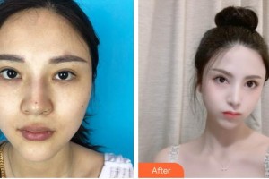 瀘州華藝整形美容診所羅吉華整形價(jià)格表附下瞼整形案例展示