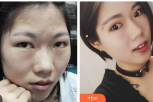 瀘州醫(yī)學(xué)院附屬醫(yī)院整形燒傷科熊愛(ài)兵整形價(jià)格表附切開雙眼皮案例展示