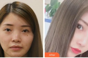 瀘州醫(yī)學(xué)院附屬醫(yī)院整形燒傷科何小川整形價(jià)格表附鼻部綜合例展示