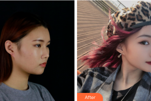 深圳美客華美醫(yī)療美容門診部袁耀東整形價格表附面部吸脂案例展示