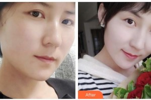 瀘州美馨醫(yī)學(xué)整形美容診所方峰整形價(jià)格表附埋線提升案例展示