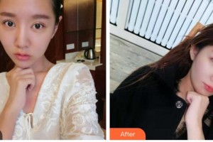 瀘州愛(ài)瑞眼科醫(yī)院梅芳整形價(jià)格表附切開(kāi)雙眼皮案例展示